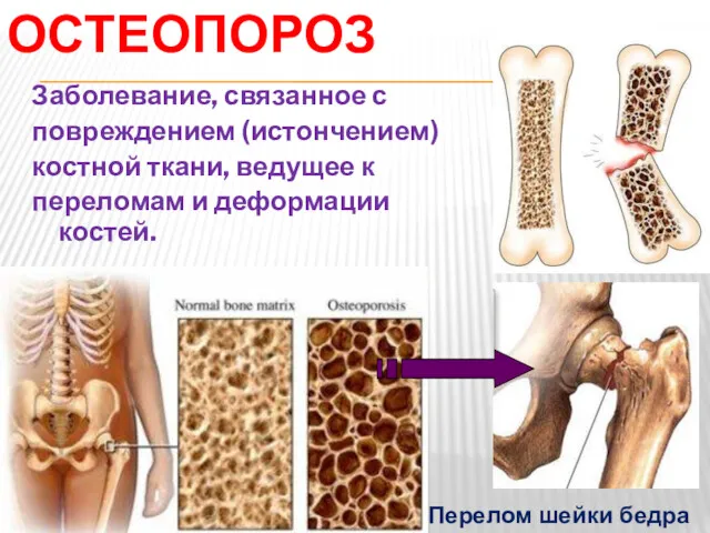 ОСТЕОПОРОЗ Заболевание, связанное с повреждением (истончением) костной ткани, ведущее к