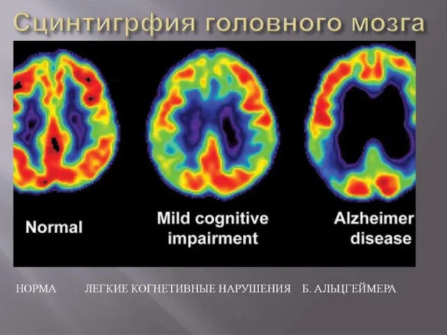 ПОЛИПРОЕКЦИОННАЯ СТАТИЧЕСКАЯ СЦИНТИГРАФИЯ Статическая сцинтиграфия головного мозга в настоящее время