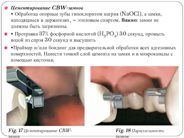 Цементирование CBW-замков • Обработка опорные зубы гипохлоритом натрия (NaOCl), а