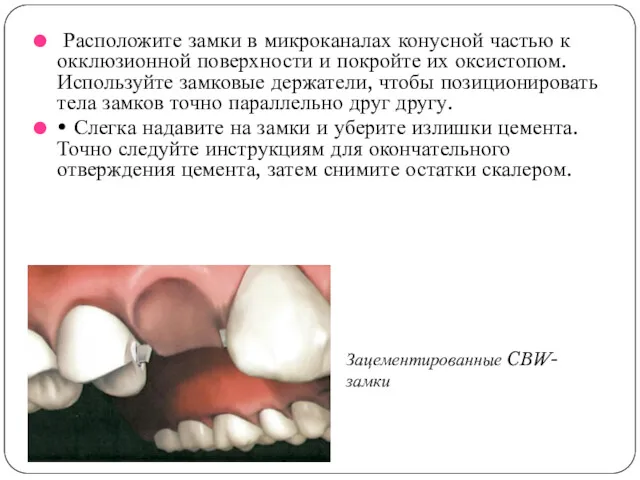 Расположите замки в микроканалах конусной частью к окклюзионной поверхности и