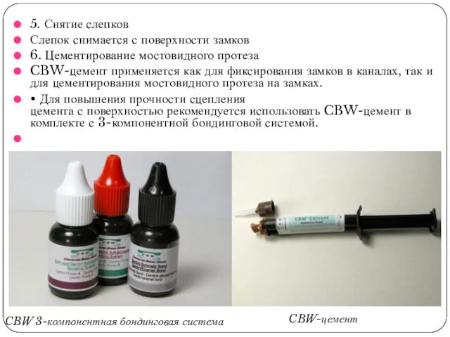 5. Снятие слепков Слепок снимается с поверхности замков 6. Цементирование