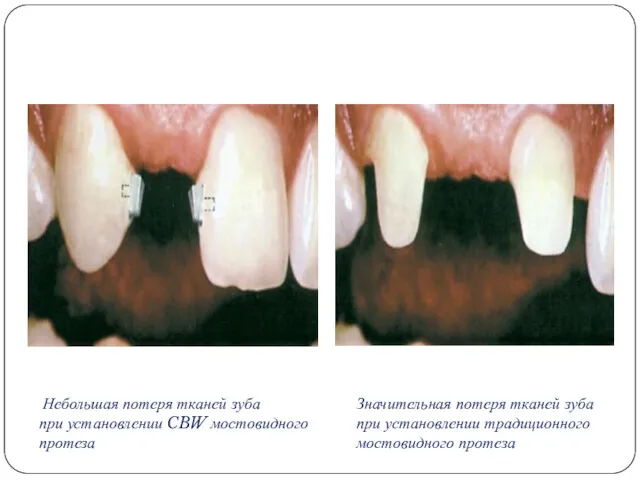 Небольшая потеря тканей зуба при установлении CBW мостовидного протеза Значительная