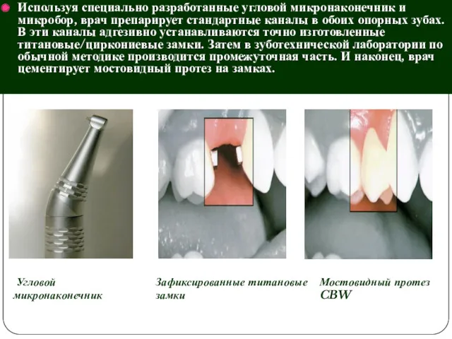 Используя специально разработанные угловой микронаконечник и микробор, врач препарирует стандартные