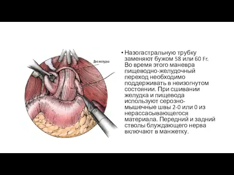 Назогастральную трубку заменяют бужом 58 или 60 Fr. Во время