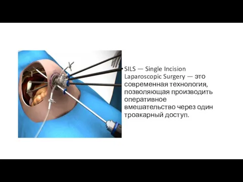 SILS — Single Incision Laparoscopic Surgery — это современная технология,