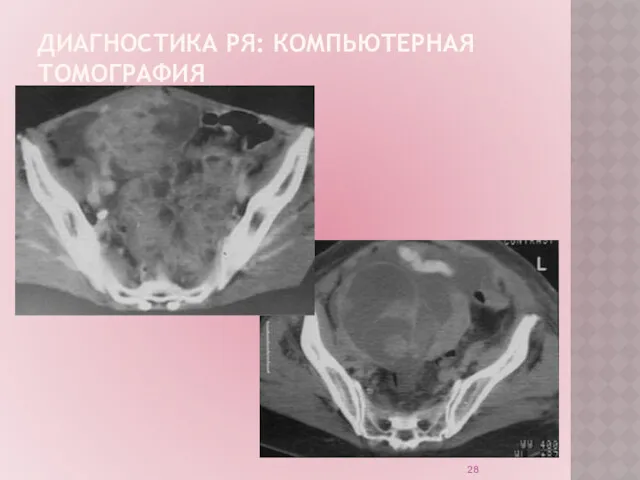 ДИАГНОСТИКА РЯ: КОМПЬЮТЕРНАЯ ТОМОГРАФИЯ