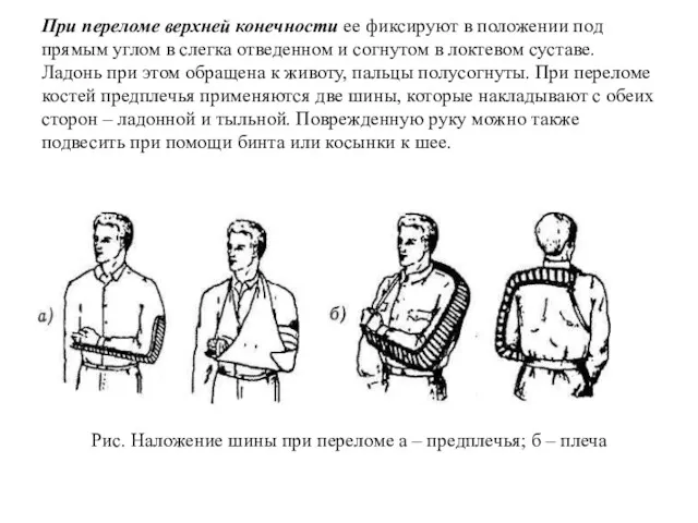 При переломе верхней конечности ее фиксируют в положении под прямым углом в слегка