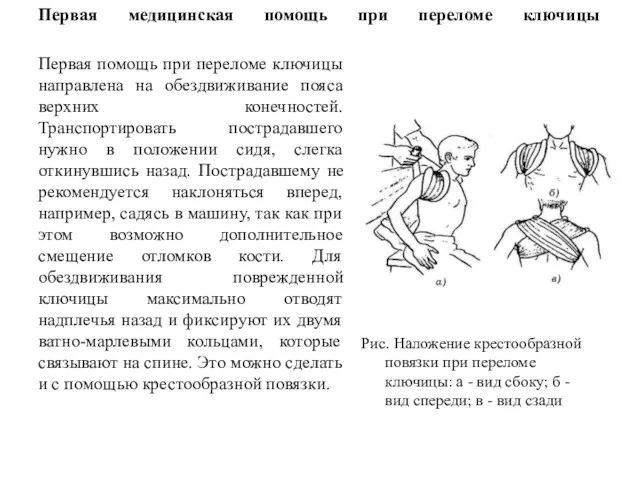 Первая медицинская помощь при переломе ключицы Первая помощь при переломе