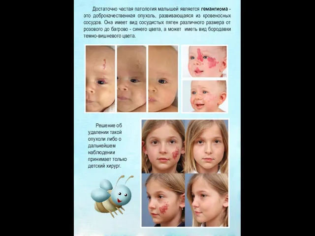 Достаточно частая патология малышей является гемангиома - это доброкачественная опухоль, развивающаяся из кровеносных