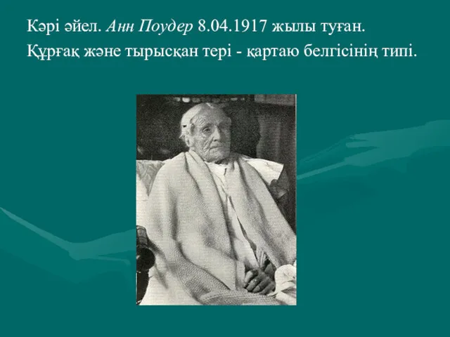 Кәрі әйел. Анн Поудер 8.04.1917 жылы туған. Құрғақ және тырысқан тері - қартаю белгісінің типі.