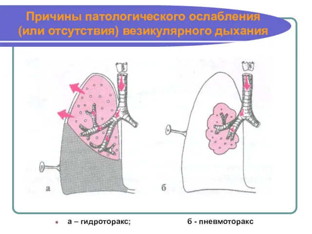 Причины патологического ослабления (или отсутствия) везикулярного дыхания а – гидроторакс; б - пневмоторакс