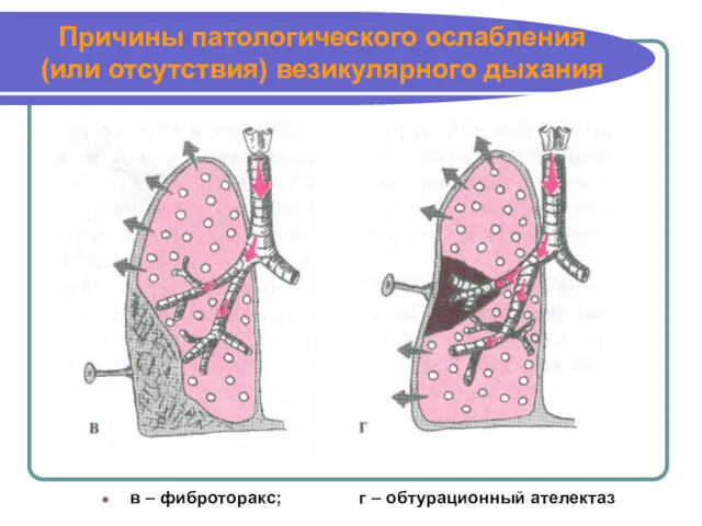 Причины патологического ослабления (или отсутствия) везикулярного дыхания в – фиброторакс; г – обтурационный ателектаз