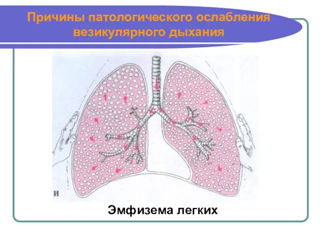 Причины патологического ослабления везикулярного дыхания Эмфизема легких
