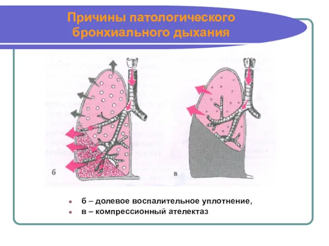 Причины патологического бронхиального дыхания б – долевое воспалительное уплотнение, в – компрессионный ателектаз
