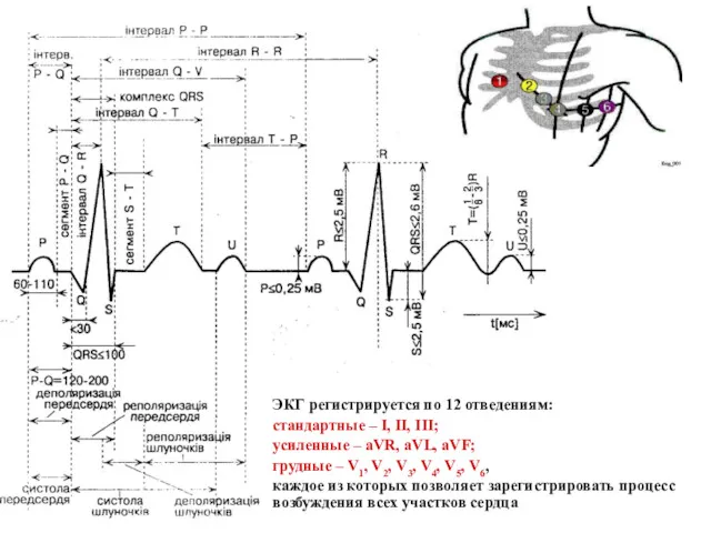 ЭКГ регистрируется по 12 отведениям: стандартные – I, II, III;