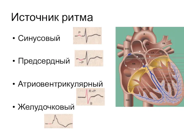 Источник ритма Синусовый Предсердный Атриовентрикулярный Желудочковый