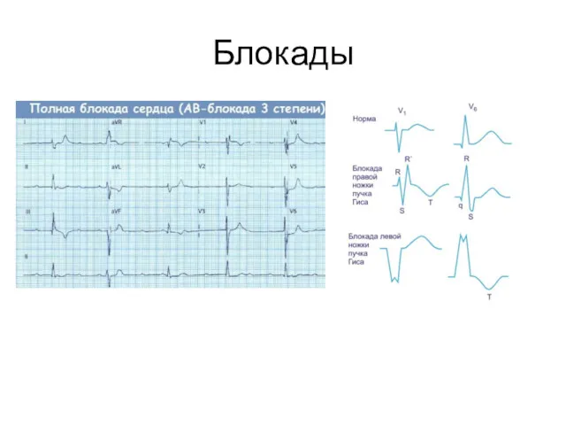 Блокады