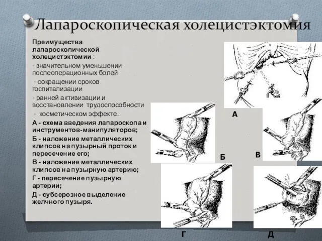 Лапароскопическая холецистэктомия Преимущества лапароскопической холецистэктомии : - значительном уменьшении послеоперационных