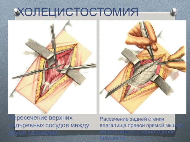 Пересечение верхних надчревных сосудов между двумя зажимами ХОЛЕЦИСТОСТОМИЯ Рассечение задней