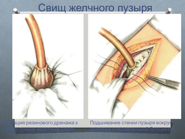 Свищ желчного пузыря Фиксация резинового дренажа к стенке пузыря кисетным