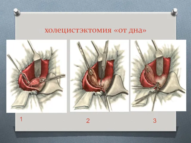 холецистэктомия «от дна» 1 2 3