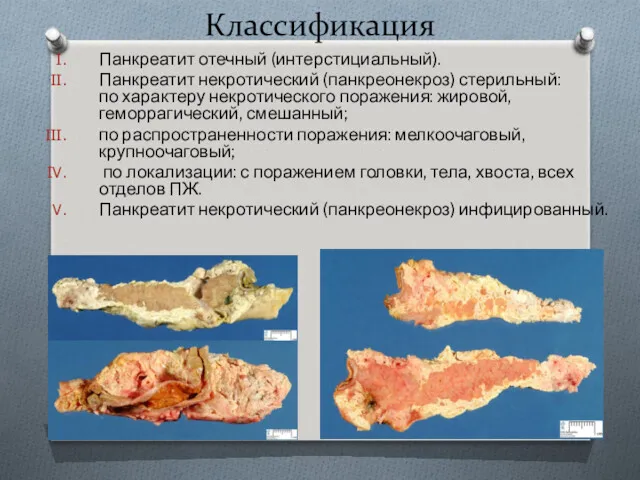 Классификация Панкреатит отечный (интерстициальный). Панкреатит некротический (панкреонекроз) стерильный: по характеру