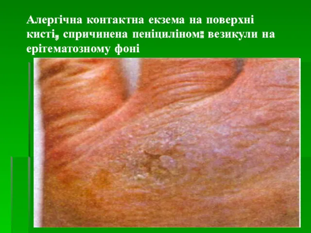 Алергічна контактна екзема на поверхні кисті, спричинена пеніциліном: везикули на ерітематозному фоні