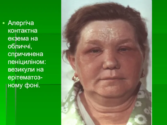 Алергіча контактна екзема на обличчі, спричинена пеніциліном: везикули на ерітематоз-ному фоні.