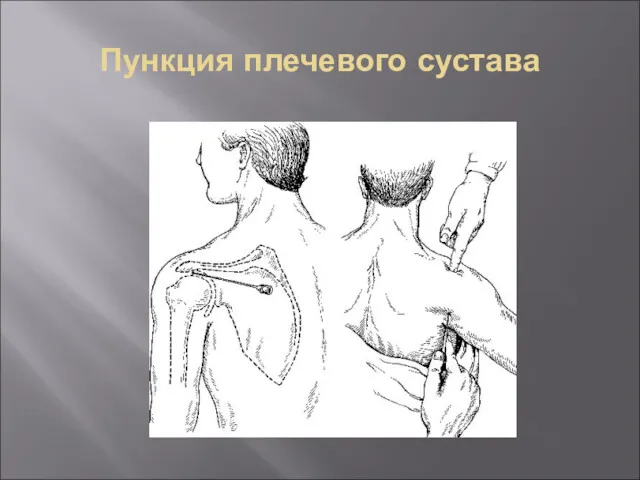 Пункция плечевого сустава