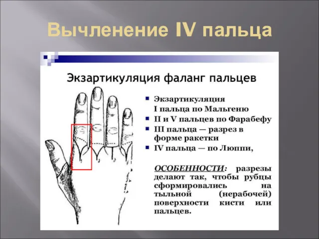 Вычленение IV пальца