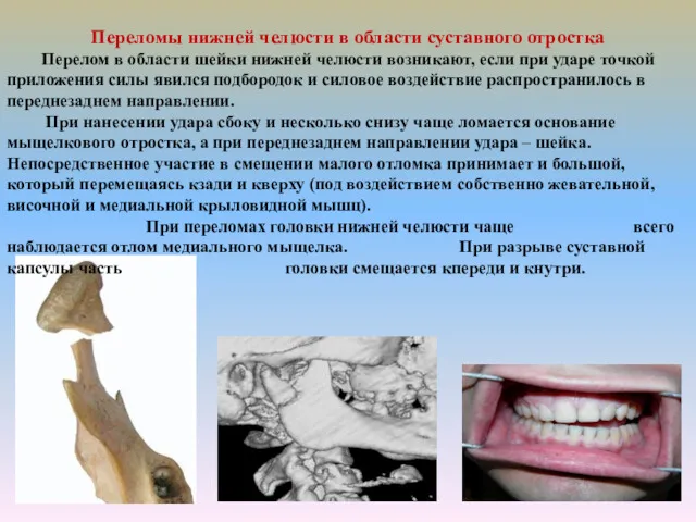 Переломы нижней челюсти в области суставного отростка Перелом в области