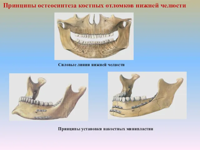 Принципы остеосинтеза костных отломков нижней челюсти Силовые линии нижней челюсти Принципы установки накостных минипластин