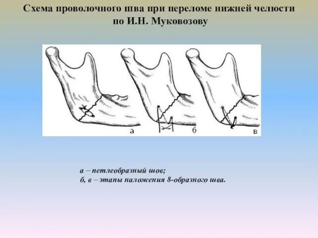 Схема проволочного шва при переломе нижней челюсти по И.Н. Муковозову а – петлеобразный