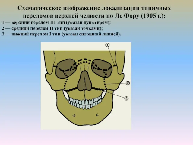 Схематическое изображение локализации типичных переломов верхней челюсти по Ле Фору (1905 г.): 1