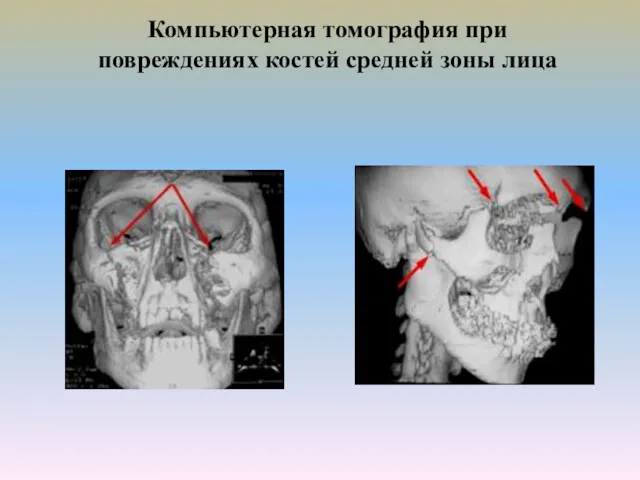 Компьютерная томография при повреждениях костей средней зоны лица