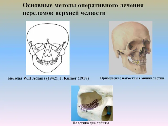 методы W.H.Adams (1942), J. Kufner (1957) Основные методы оперативного лечения переломов верхней челюсти