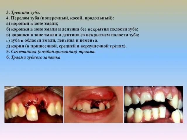 3. Трещина зуба. 4. Перелом зуба (поперечный, косой, продольный): а) коронки в зоне
