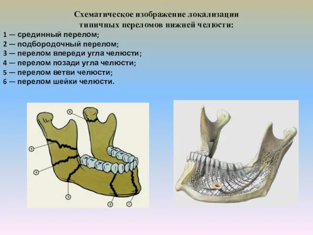 Схематическое изображение локализации типичных переломов нижней челюсти: 1 — срединный перелом; 2 —