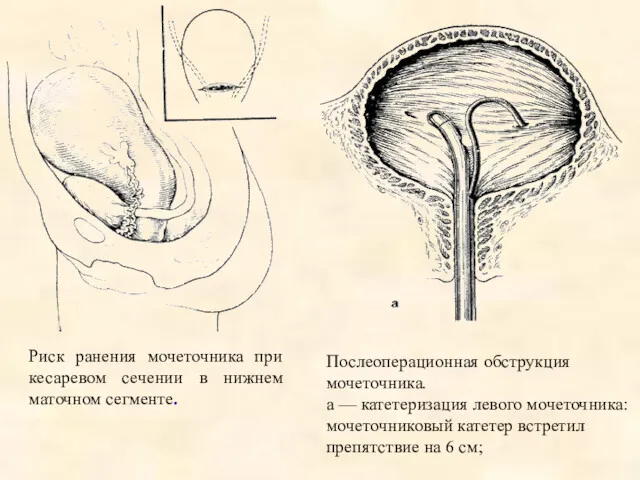 Риск ранения мочеточника при кесаревом сечении в нижнем маточном сегменте.