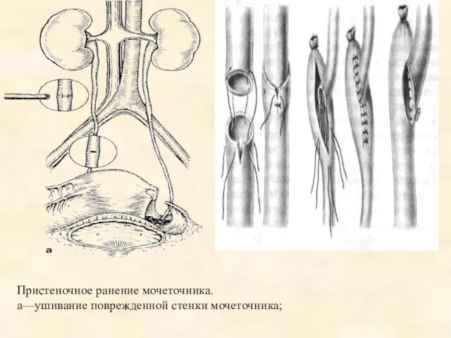 Пристеночное ранение мочеточника. а—ушивание поврежденной стенки мочеточника;