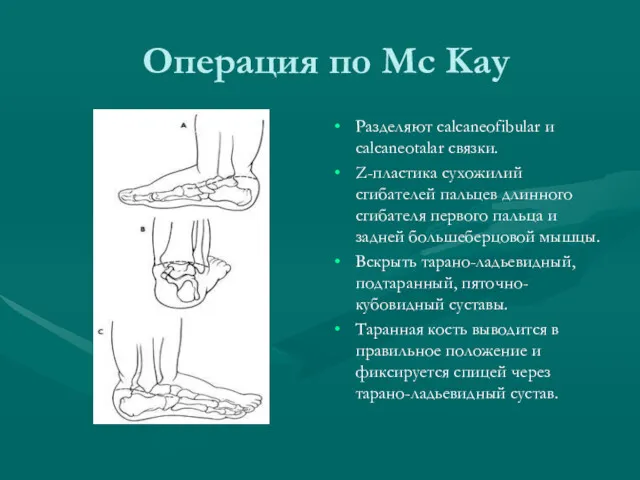 Операция по Мс Kay Разделяют calcaneofibular и calcaneotalar связки. Z-пластика