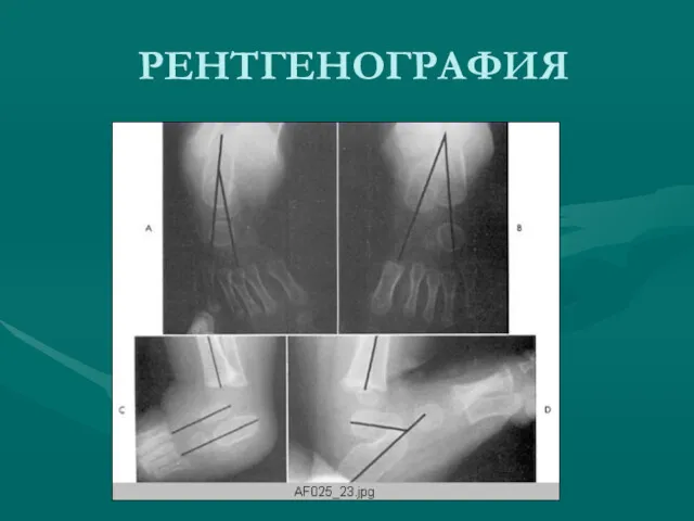 РЕНТГЕНОГРАФИЯ