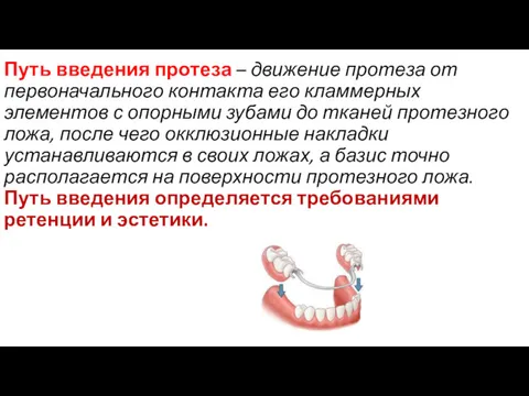 Путь введения протеза – движение протеза от первоначального контакта его