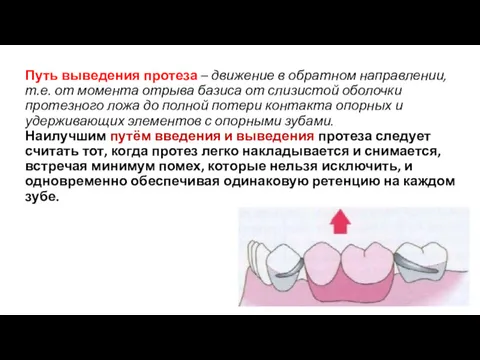 Путь выведения протеза – движение в обратном направлении, т.е. от