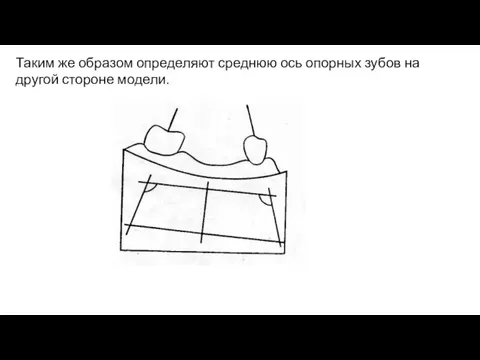 Таким же образом определяют среднюю ось опорных зубов на другой стороне модели.