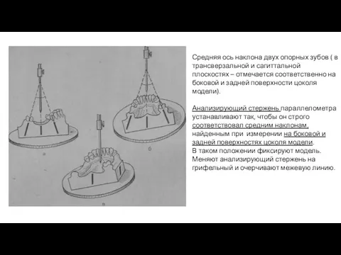 Средняя ось наклона двух опорных зубов ( в трансверзальной и