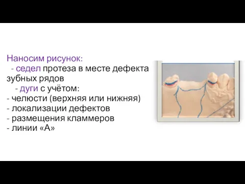 Наносим рисунок: - седел протеза в месте дефекта зубных рядов