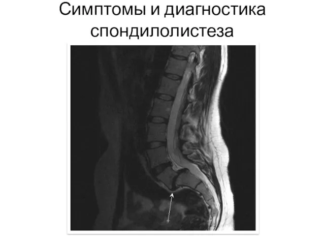 Симптомы и диагностика спондилолистеза