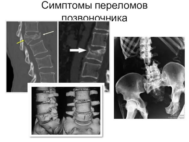 Симптомы переломов позвоночника