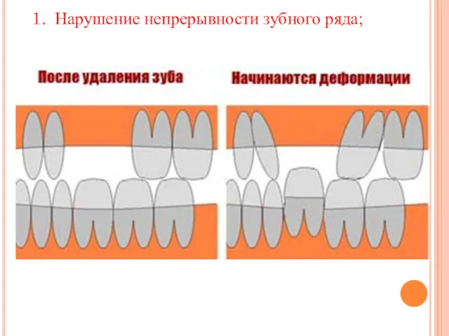 Нарушение непрерывности зубного ряда;